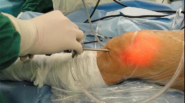 可对关节进行动力性检查,提高了诊断能力,某些疾病如滑膜皱襞综合征