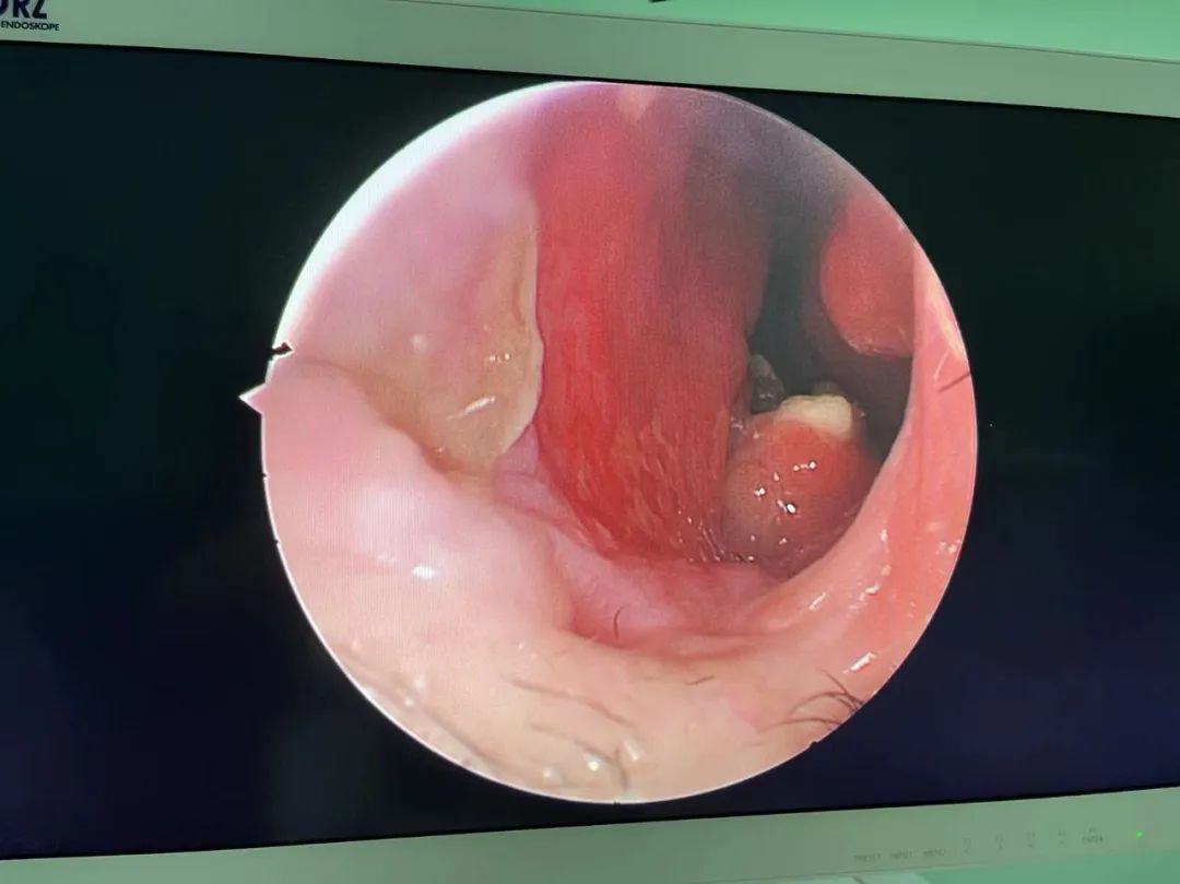 奇牙齿长在鼻腔内看医生如何鼻内拔牙