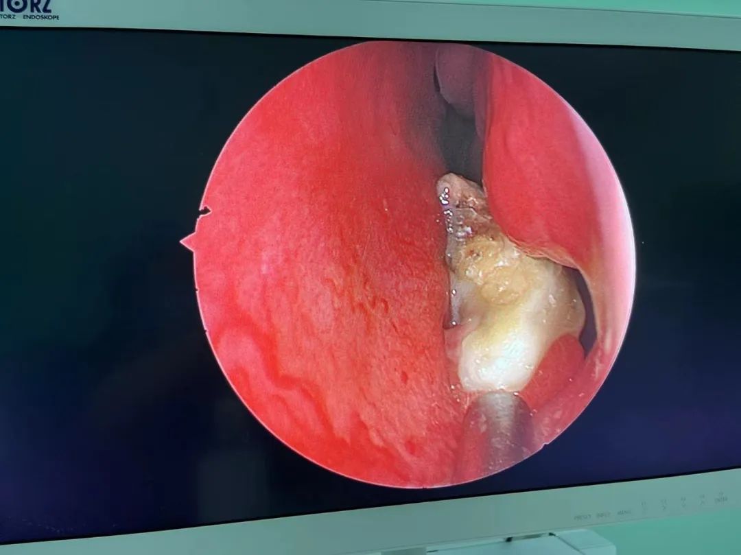 接诊医师使用鼻内镜为孩子完善鼻腔检查,检查过程中,在孩子的左侧鼻腔